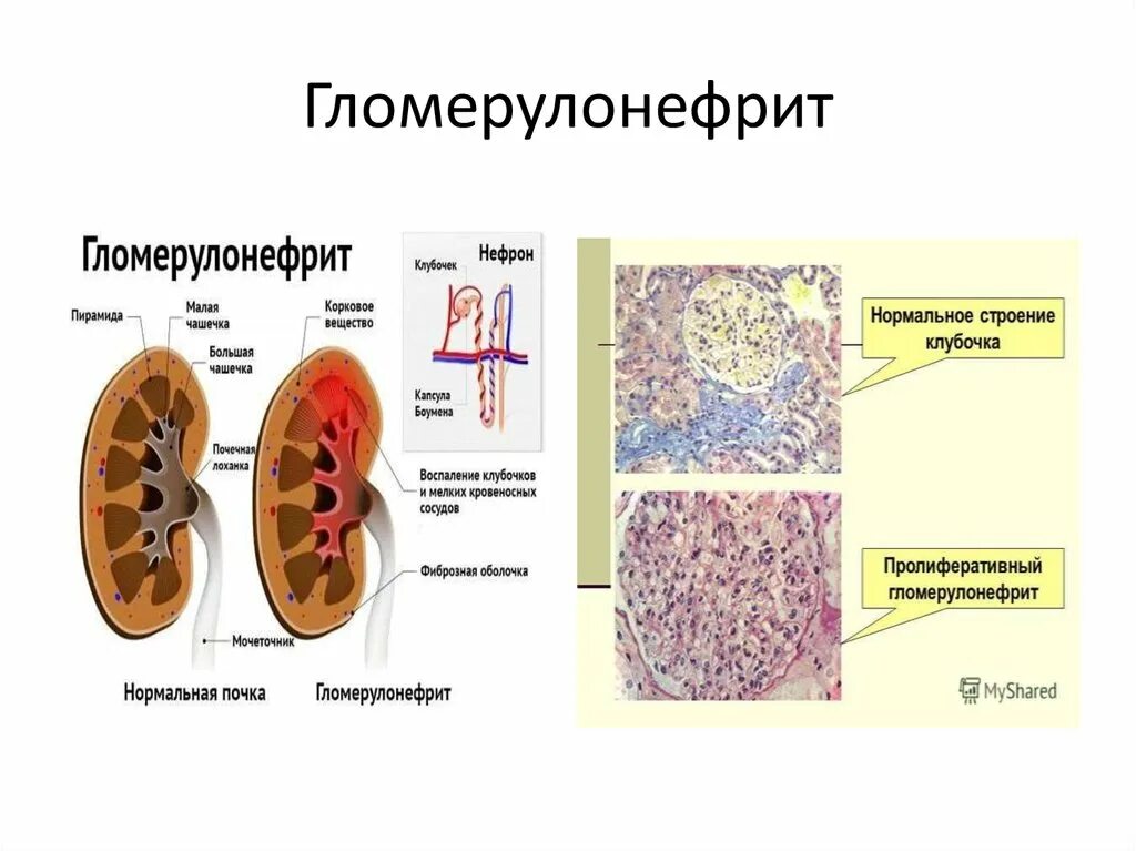 Гломерулонефрит почечный клубочек. Гломерулонефрит воспаление клубочков почки. Гломерулонефрит характеризуется воспалением. Поражение клубочков гломерулонефрит. Поражение клубочков почек