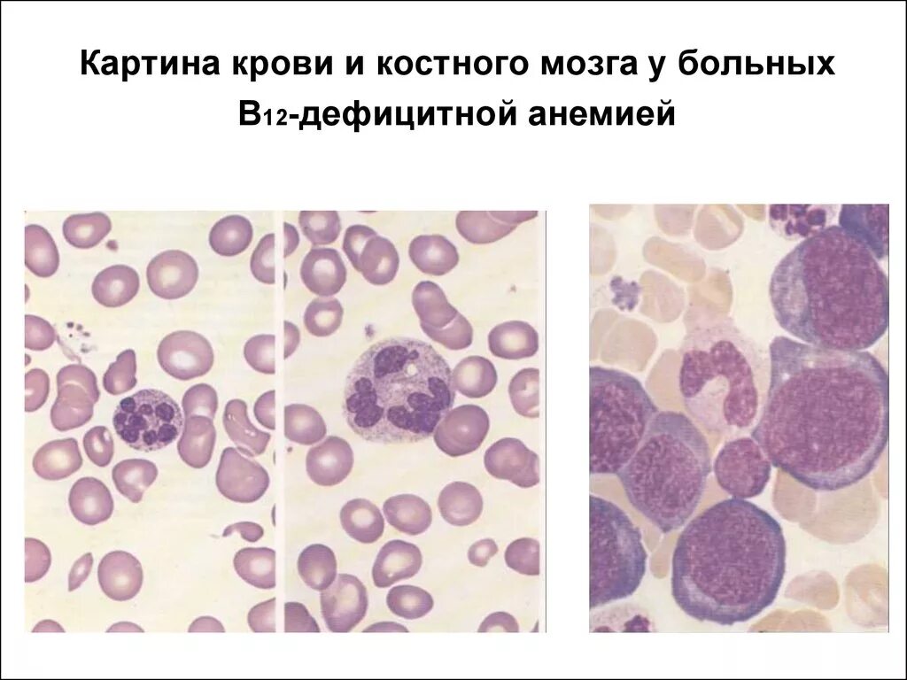 В12 при железодефицитной анемии. Картина крови при в12-фолиеводефицитной анемии. Костный мозг при б12 дефицитной анемии. Б12 дефицитная анемия картина крови. Мазок крови при в12 фолиеводефицитной анемии.