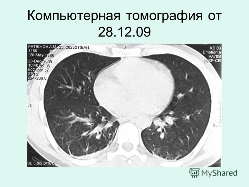 Компьютерная томография легких. Резонансный диск. Компьютерная томография (с записью на диск). Драйвера ritmix. Диск мрт.