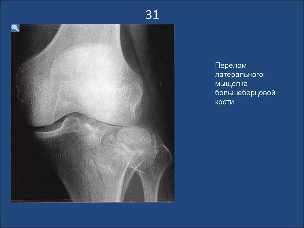 Перелом мыщелка большой. Перелом мыщелков большеберцовой кости рентген. Мыщелка большеберцовой кости. Внутрисуставной перелом медиального мыщелка большеберцовой кости. Импрессионный перелом латерального мыщелка бедра.