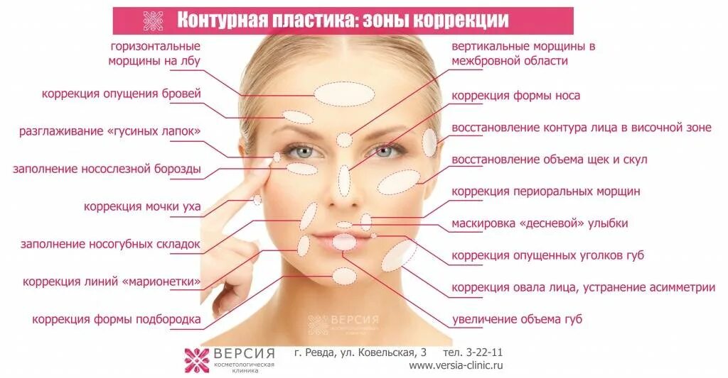 Сыпь на лице причины по зонам. Контурная пластика схемы введения. коррекция носогубных складок схема. зоны введения филлеров на лице. схема введения филлеров в лицо.