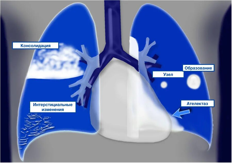 фокусы инфильтрации. инфильтративный туберкулез рентген. фокусы инфильтрации. фокусы инфильтрации. синдром воспалительной инфильтрации легких (уплотнение).