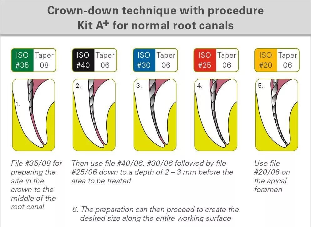 Crown down техника в эндодонтии. Методики расширения корневых каналов crown down. crown down расширения корневого канала. методика crown down в стоматологии. методика механической обработки корневых каналов crown down.