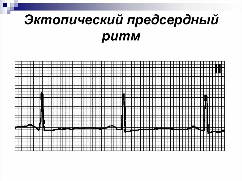 Эктопический предсердный ритм на ЭКГ. Эктопический нижнепредсердный ритм на ЭКГ. Эктопический ритм сердца на ЭКГ. Ускоренный эктопический предсердный ритм. Эктопический предсердный ритм что это