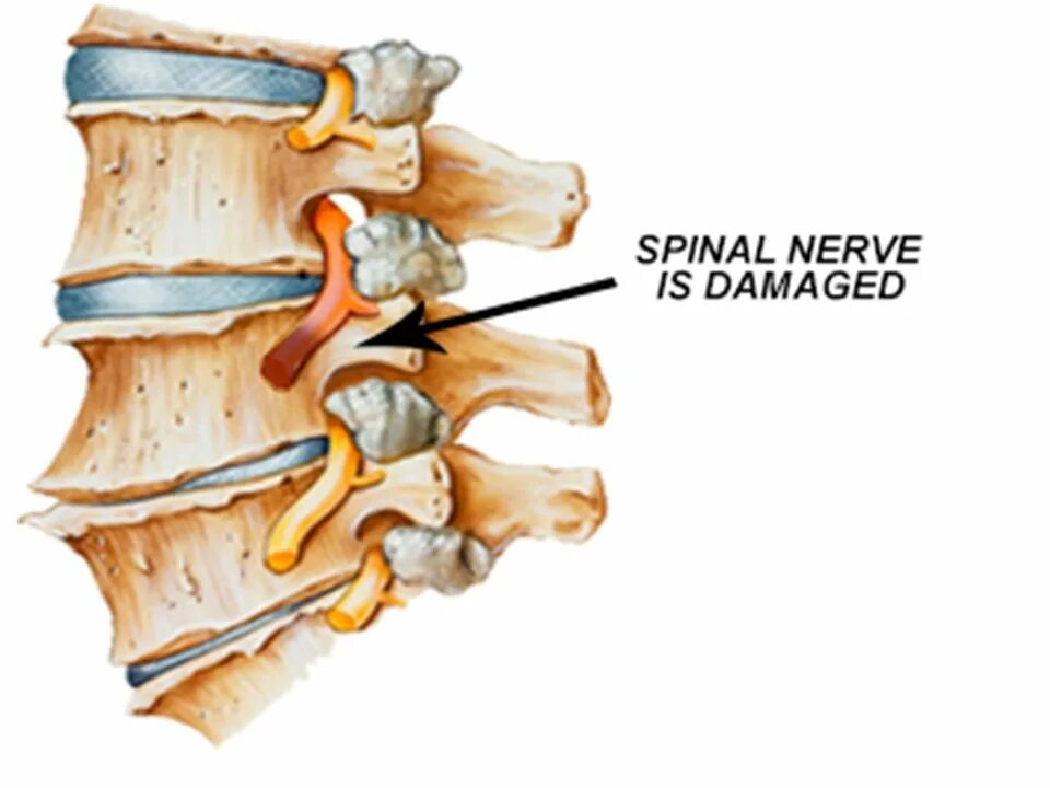 Защемление нерва в спине поясница. Ущемление нерва в поясничном отделе l5 s1. Защемление нерва 5 шейный позвонок. Защемление нервных Корешков в шейном отделе позвоночника. Защемление нервных Корешков в пояснице.