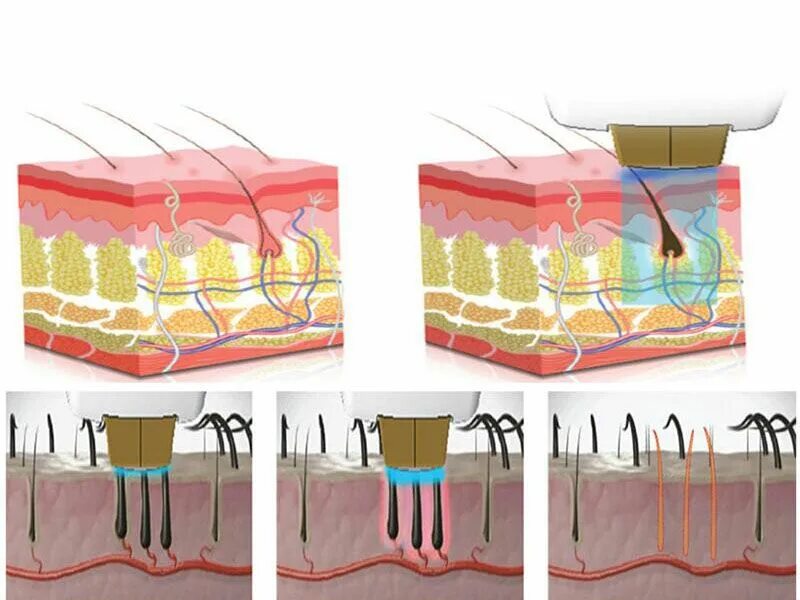 Лазерное воздействие на кожу skinlift ru. Диодный лазер фокусируется на фолликуле. Техника введения диодного лазера на кожу. Охлаждение манипулы диодного лазера. 808 NM ADG трехволновый лазерный аппарат hair removal sistem.