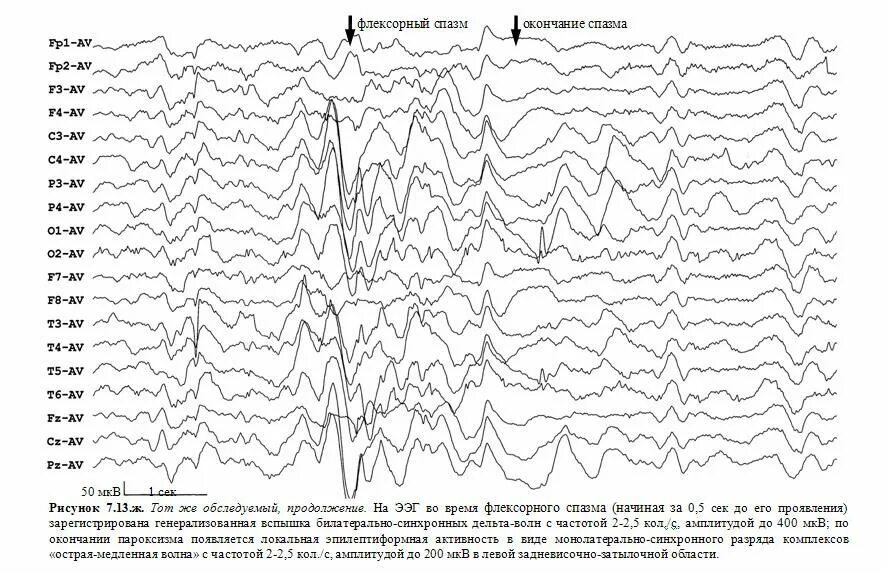 Медленные волны на ээг. Комплекс острая медленная волна на ЭЭГ. Острая волна медленная волна на ЭЭГ. Пик волна на ЭЭГ. Генерализованные комплексы пик волна на ЭЭГ.