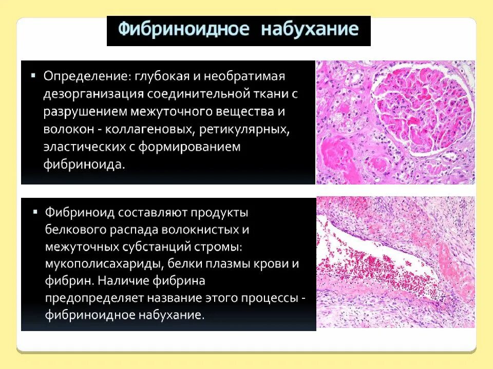 Мезенхимальные дистрофии. Мезенхимальные дистрофии патологическая анатомия. дистрофия патанатомия. мезенхимальные дистрофии патанатомия. углеводные дистрофии патанатомия.