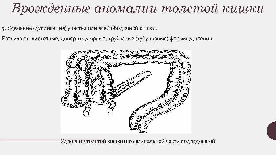 Удлиненный кишечник. Аномалия развития Толстого кишечника долихосигма. Аномалии развития толстой кишки. Лучевая диагностика.. Долихосигма пороки толстой кишки. Пороки развития тонкого кишечника.