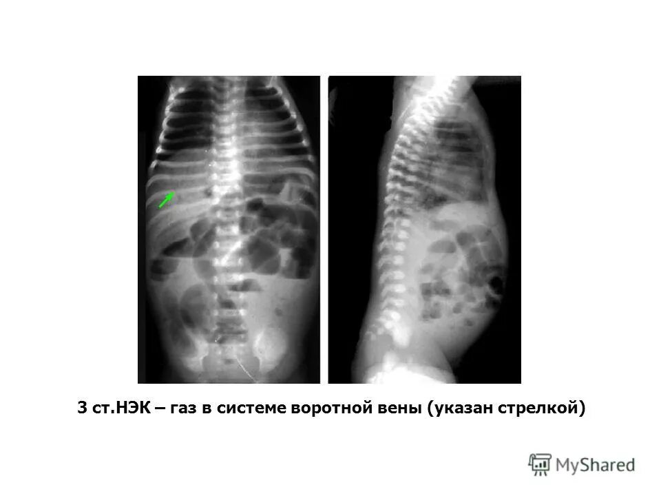 некротизированный энтероколит у новорожденных. некротизированный энтероколит у новорожденных. нэк у новорожденных рентген. некротизированный энтероколит у новорожденных. некротический энтероколит рентгенограмма.