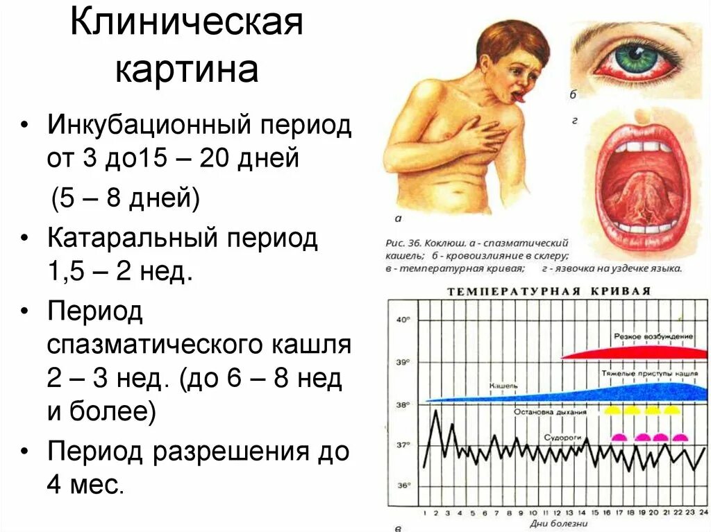 Коклюш характерные клинические проявления заболевания. Коклюш у детей клинические проявления. Клинические симптомы коклюша. Основные проявления коклюша.