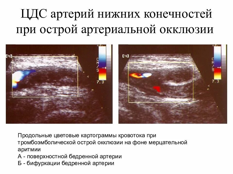 УЗИ артерий нижних конечностей протокол УЗИ. Тромбоз поверхностной бедренной артерии на УЗИ. Окклюзия бедренной артерии на УЗИ. Атеросклероз артерий нижних конечностей на УЗИ. Узи вен тромбоз