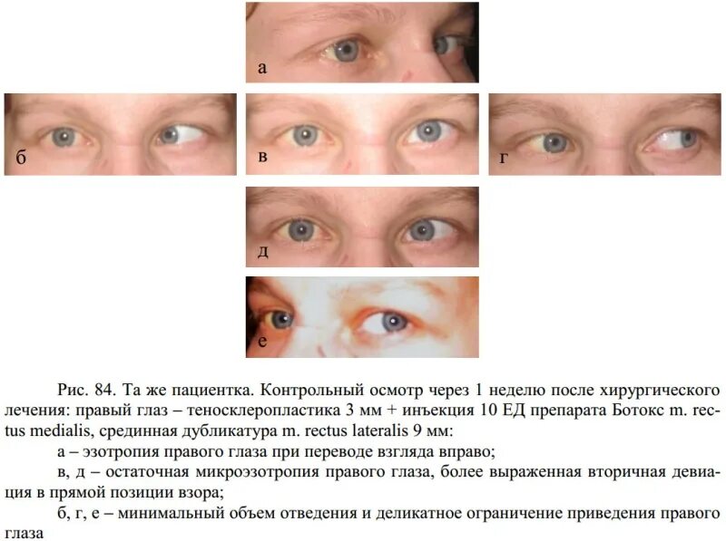 Операция на косоглазие цена. После операции на косоглазие. Ботокс в глаза от косоглазия. Ботулотоксин косоглазие.