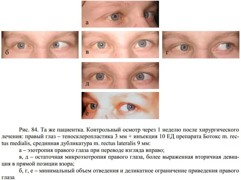 После операции на косоглазие. Ботокс в глаза от косоглазия. Ботулотоксин косоглазие.