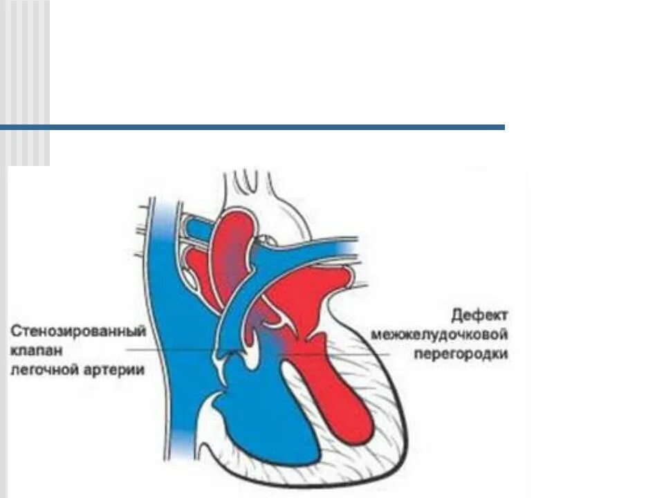 Уплотнение стенок аорты