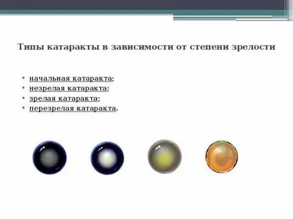 Возрастная катаракта