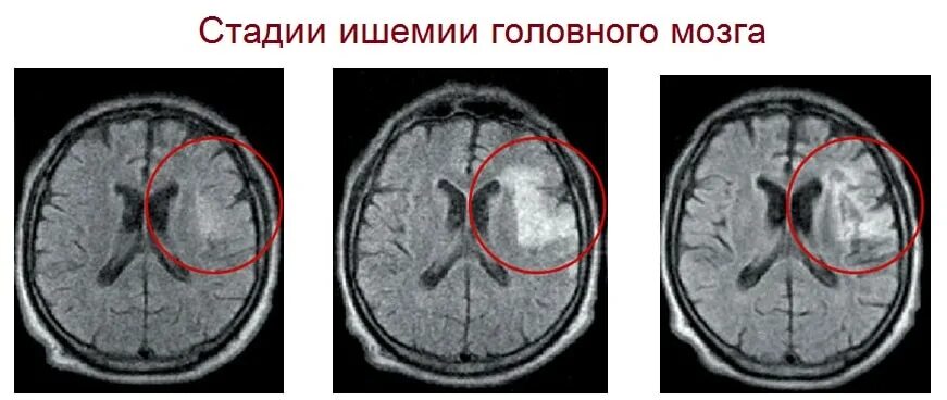 2 стадия головного мозга. Очаги ишемии головного мозга на мрт. степени ишемии головного мозга степени. хроническая ишемия головного мозга на кт. хроническая ишемия головного мозга 2 степени что это такое.