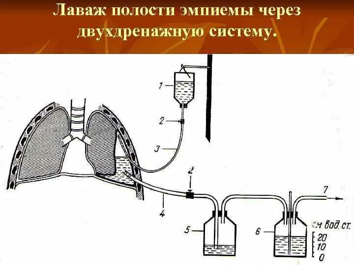 Плевральный дренаж Бюлау. Схема активной аспирации из плевральной полости. Дренирование плевральной полости с активной вакуум-аспирацией. Проточно промывное дренирование. После вакуумный аспирация форум