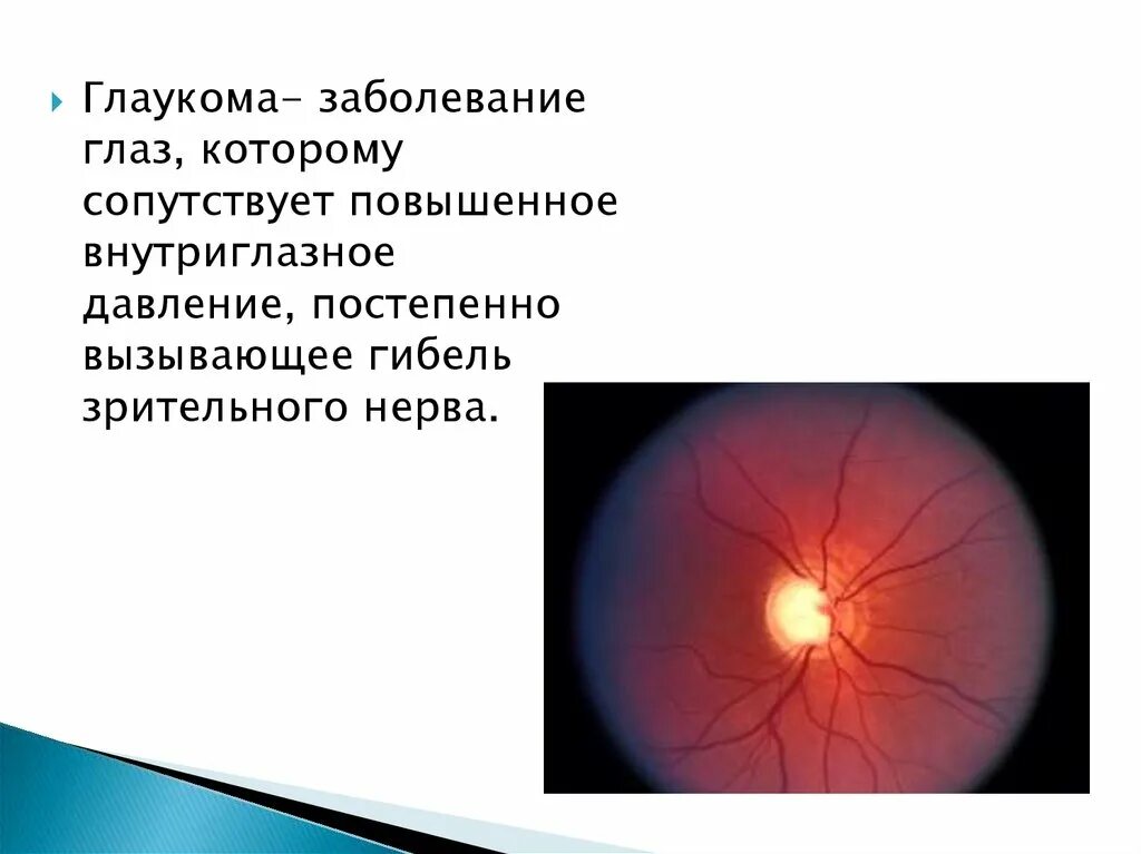 Что делать при глаукоме глаза. Глаукома причины возникновения.