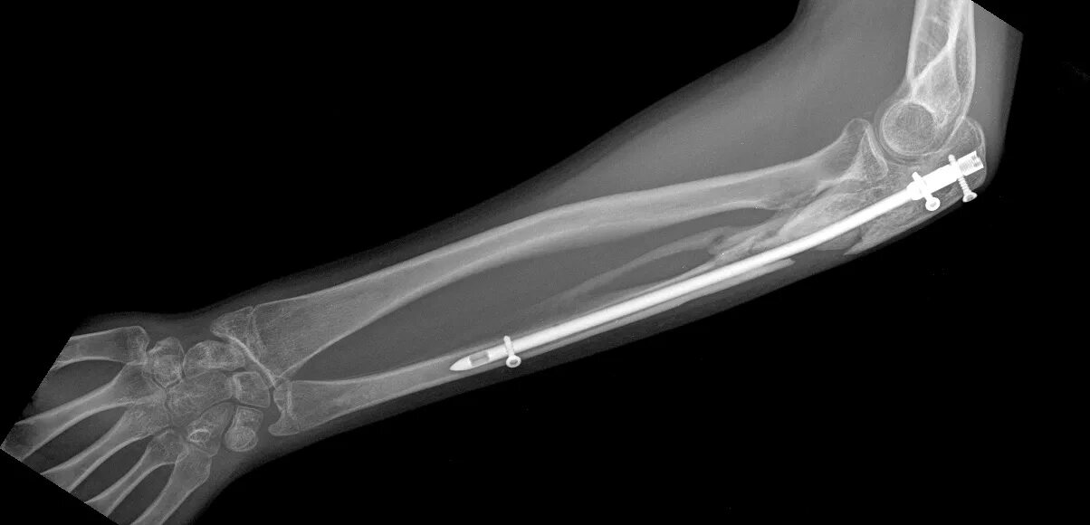 сколько рентгенов делают при переломе. перелом костей предплечья рентген. чрескостный остеосинтез рентгенограмма. корригирующая остеотомия бедренной кости рентген. сколько рентгенов делают при переломе.