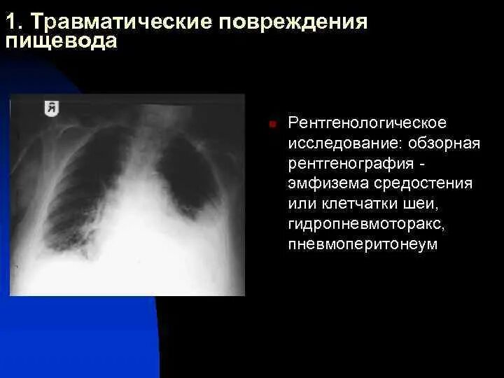 Медиастинальная эмфизема рентген. Травматические повреждения пищевода. Подкожная эмфизема средостения. Повреждение пищевода рентген.