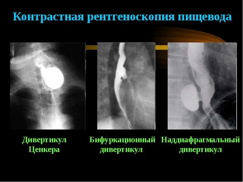 Локализация пищевода. Наддиафрагмальный дивертикул пищевода на рентгене. Эпинефральный дивертикул пищевода. Бифуркационный дивертикул пищевода рентген. Дивертикул пищевода рентген признаки.