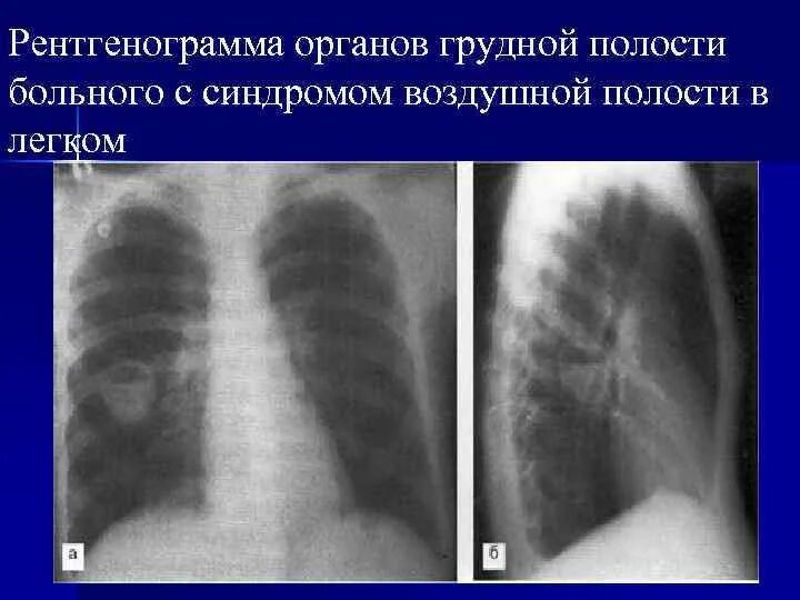 Образование полостей в легких