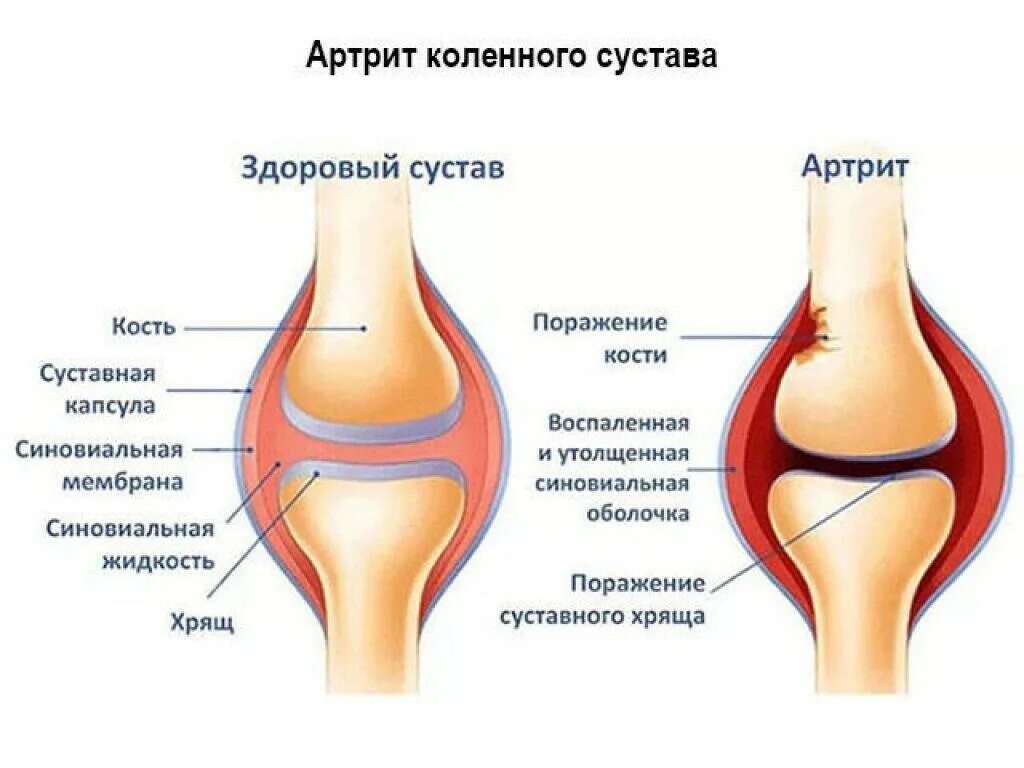 Формы поражения суставов. Заболевания суставов коленей. Формы поражения суставов. Стадии развития суставов. Строение сустава.