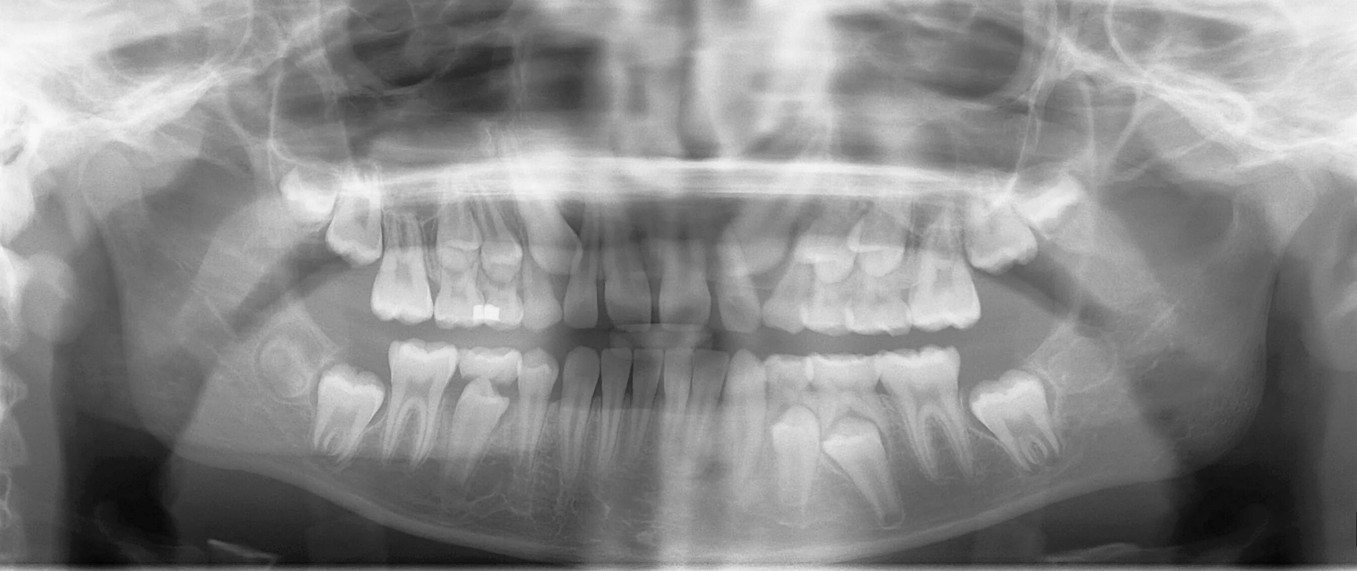 Панорамная рентгенограмма верхней челюсти. Рентгенография в прикус. Увеличенная панорамная рентгенография. Рентгенограмма сменного прикуса.