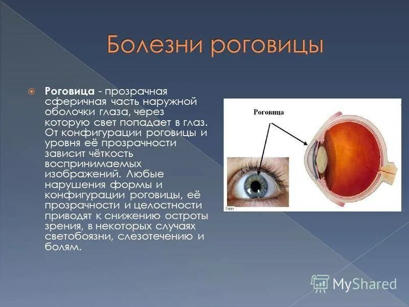 Роговица слизистая оболочка. Здоровая роговица глаза. Роговица образована