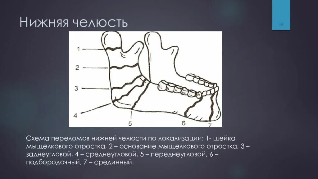 Перелом мыщелкового отростка нижней челюсти. Мыщелковый отросток нижней челюсти перелом. Перелом нижней челюсти лучевая диагностика. Переломы нижней челюсти рентген анатомия. Мыщелок челюсти