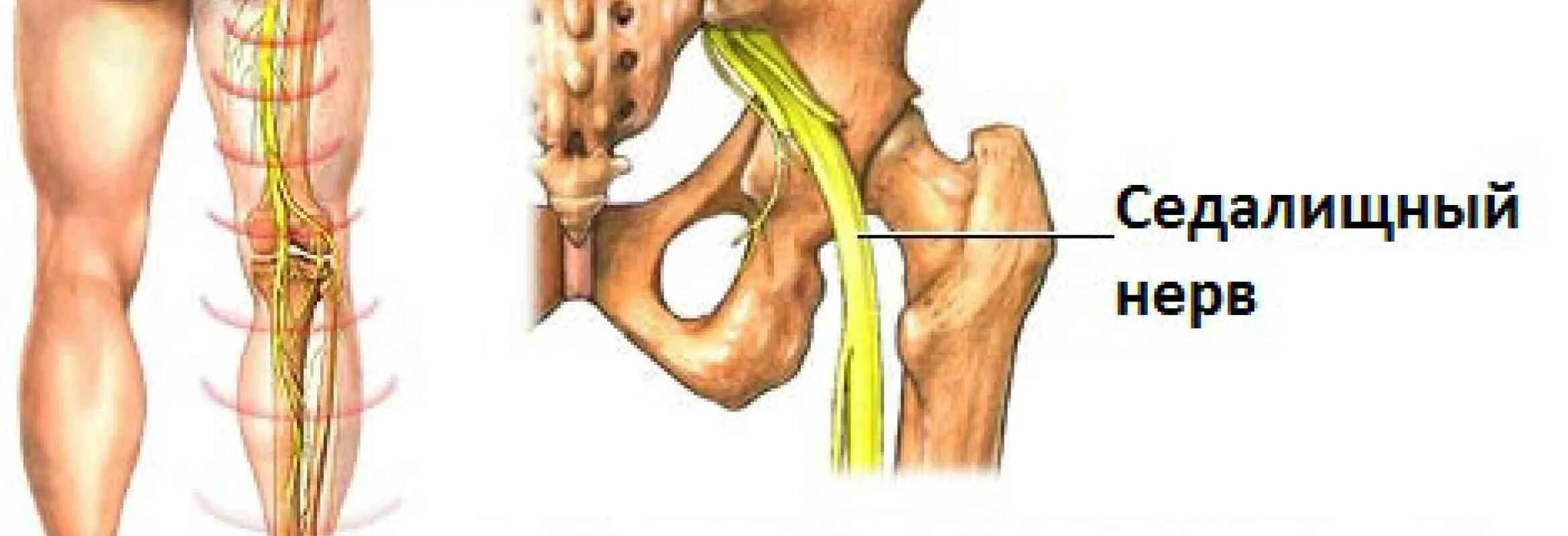 Ишиас воспаление седалищного нерва. Защемление седалищного нерва на рентгене. Защемление седалищного нерва ЛФК. Седалищный нерв (sciatic nerve)? 011. Седалищный нерв в пояснице