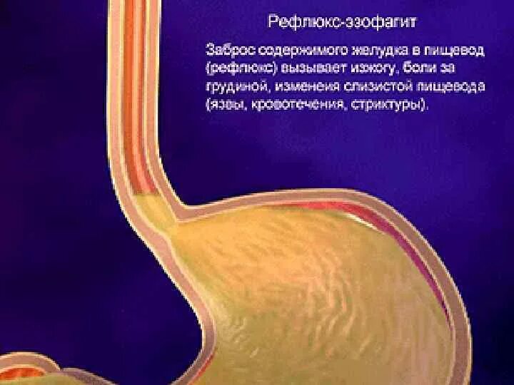 Рефлюкс эзофагит. Дистальный рефлюкс эзофагит. дистальный неэрозивный рефлюкс-эзофагит.