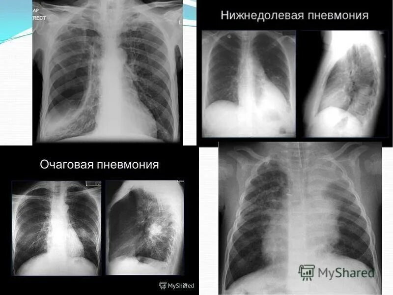 Очаговый бронхит. Прикорневая пневмония рентген. Очагтвая пневмония на рентеге. Снимок при пневмонии у ребенка. Нижнедолевая пневмония рентген.