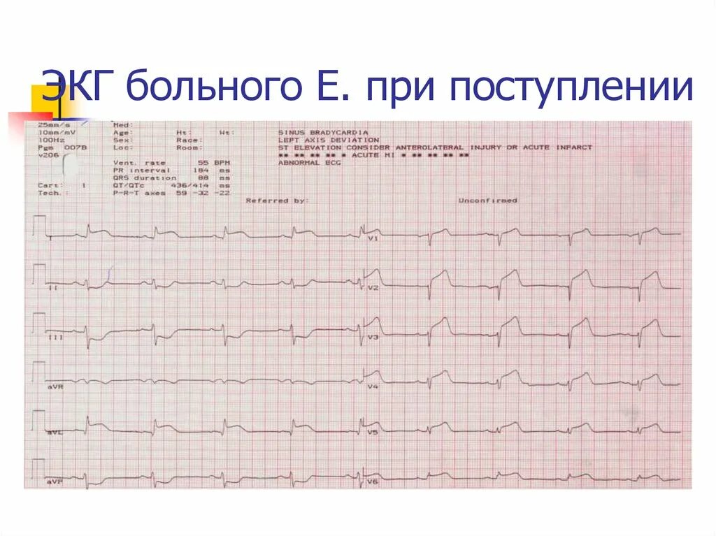 Карта вызова ибс. Фибрилляция предсердий и инфаркт миокарда на ЭКГ. ЭКГ здорового сердца расшифровка. ЭКГ больного человека. Описание электрокардиограммы.