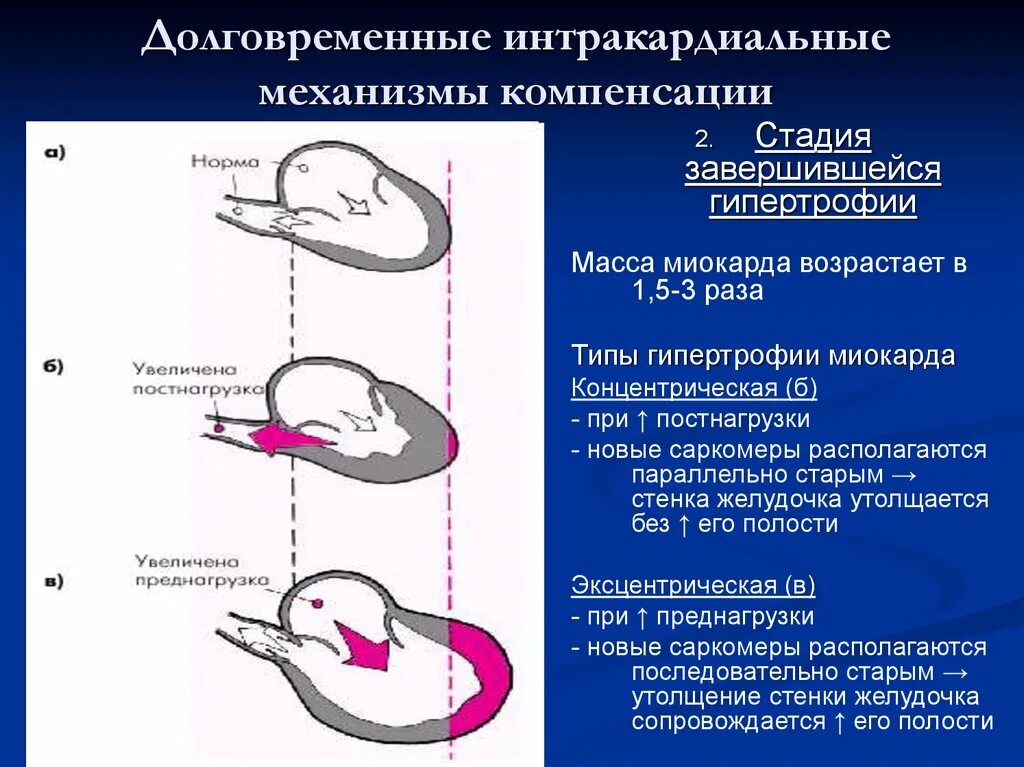 Гипертрофия полостей сердца. Концентрическая и эксцентрическая гипертрофия. стадии гипертрофии миокарда патофизиология. интрикариальные механизм. интракардиальные механизмы компенсации.