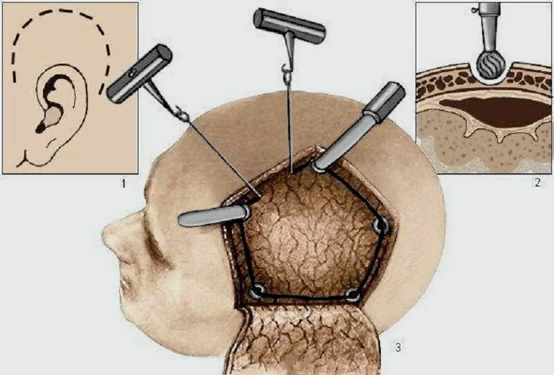 Пересадка головного мозга. Бифронтальная Трепанация. Трепанация черепа операция. Нейрохирургия Трепанация черепа. Резекционная Трепанация черепа.
