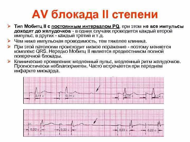 Сколько можно делать блокаду. ЭКГ признаки АВ блокады 2 степени Мобитц 2. АВ блокада 2 степени типа Мобиц 2. АВ блокада 2 степени Мобитц 2 характеризуется:. Атриовентрикулярная блокада 2 степени Мобитц 1 на ЭКГ.