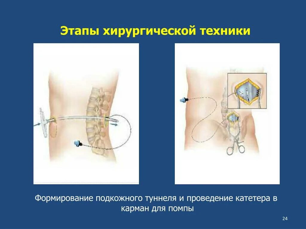 Баклофеновых помп. Формирование подкожного туннеля. Баклофеновой помпы. Порядок формирования подкожного туннеля. Формирования подкожного туннеля инструменты.