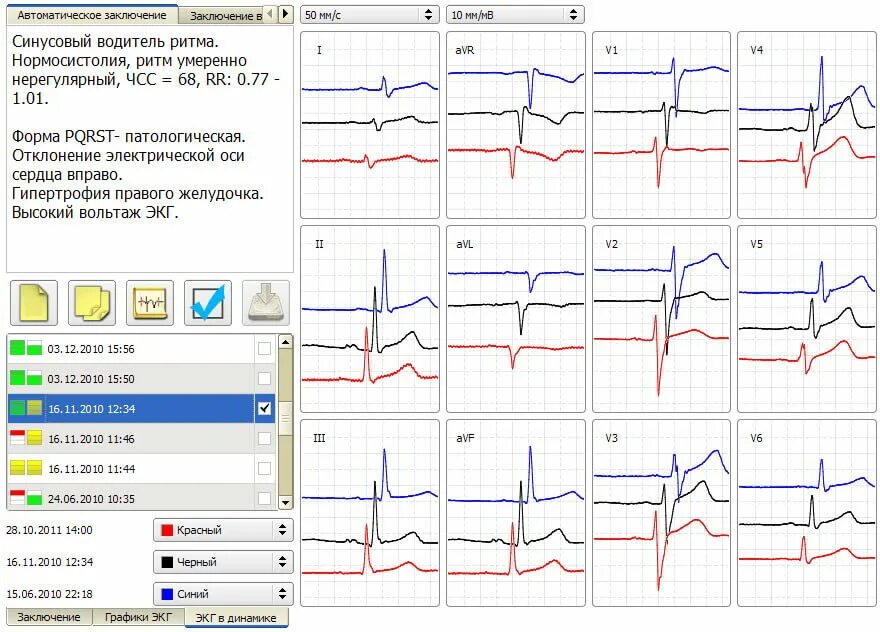 Интерпретация результатов ЭКГ алгоритм. Интерпретация результатов электрокардиограммы ЭКГ. ЭКГ нерегулярность ритма норма. Алгоритм интерпретации ЭКГ. Соп экг