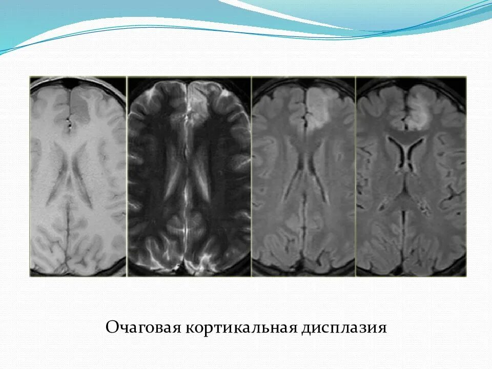 Лобная эпилепсия. Очаговая кортикальная дисплазия. Фокальная кортикальная дисплазия. Фокальная кортикальная дисплазия баллонные клетки. Эпилепсия лобной доли.