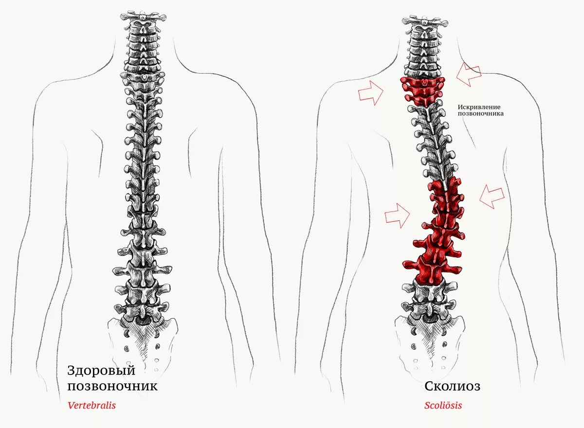 Позвоночник человека сколиоз. Деформация позвоночника, сколиоз. Сколиоз позвоночника схема. Двухсторонний сколиоз позвоночника.