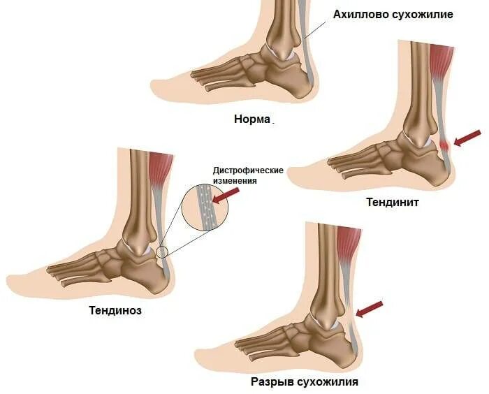 Болят пятки при ходьбе причины у мужчин. Болит пятка при наступании и ходьбе. Сильная боль в пятке при наступании. Болит пятка при наступании причины. Пяточная кость болит при наступании и ходьбе.