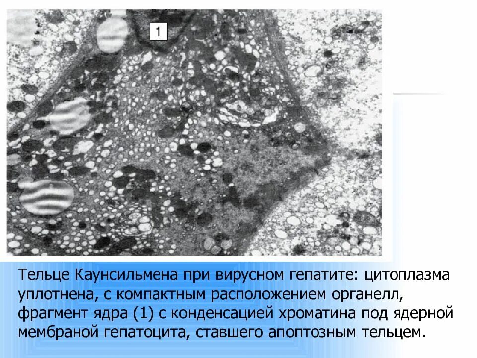 Тельца каунсильмена при гепатите Электронограмма. Электронограмма апоптозное тельце при гепатите. Тельца каунсильмена при вирусном гепатите. Апоптозные тельца каунсильмена. Многочисленные мелкие тельца