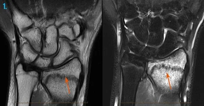 Делают ли мрт руки. Патология лучезапястного сустава мрт. Т1 и т2 мрт кости. Стилоидит лучезапястного сустава на мрт.