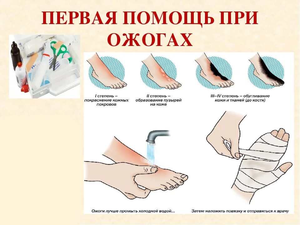 Что следует сделать при ожоге. Оказание первой медпомощи при ожогах. при термическом ожоге при оказании первой помощи необходимо. первая помощь при несильном ожоге кожи. оказание первой помощи при ожоге 1 степени.