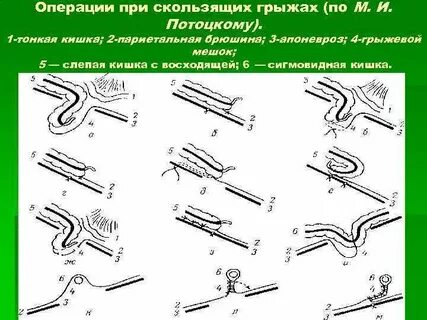 Грыжи операции хирургия
