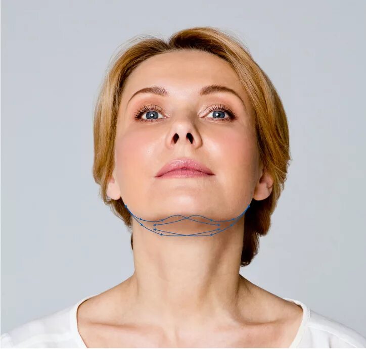 нити аптос nano vitis. нитевой лифтинг шеи. нити аптос для подтяжки подбородка. вирсавия нитевой лифтинг. подтяжка шеи нитями аптос.