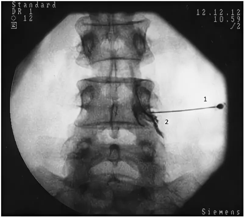 Фасеточная блокада. Эпидуральная блокада поясничного. Блокада фасеточных суставов под контролем рентгена. Блокада эпидуральная под рентгенологическим контролем. Трансфораминальная эпидуральная блокада l5-s1.