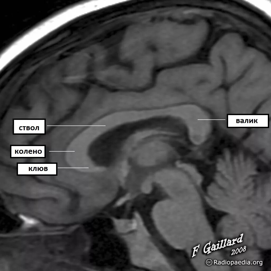 Ирритация коры головного мозга. Мозолистое тело анатомия мрт. Мрт головного мозга мозолистое тело. Анатомия мозолистого тела головного мозга мрт. Мозолистое тело на кт анатомия.